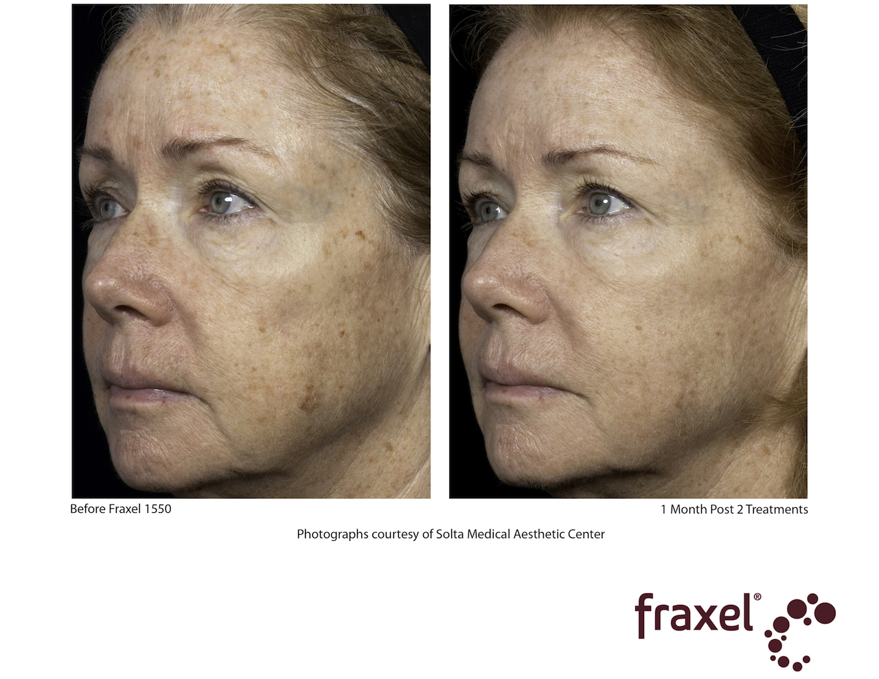 Fraxel treatment before and after