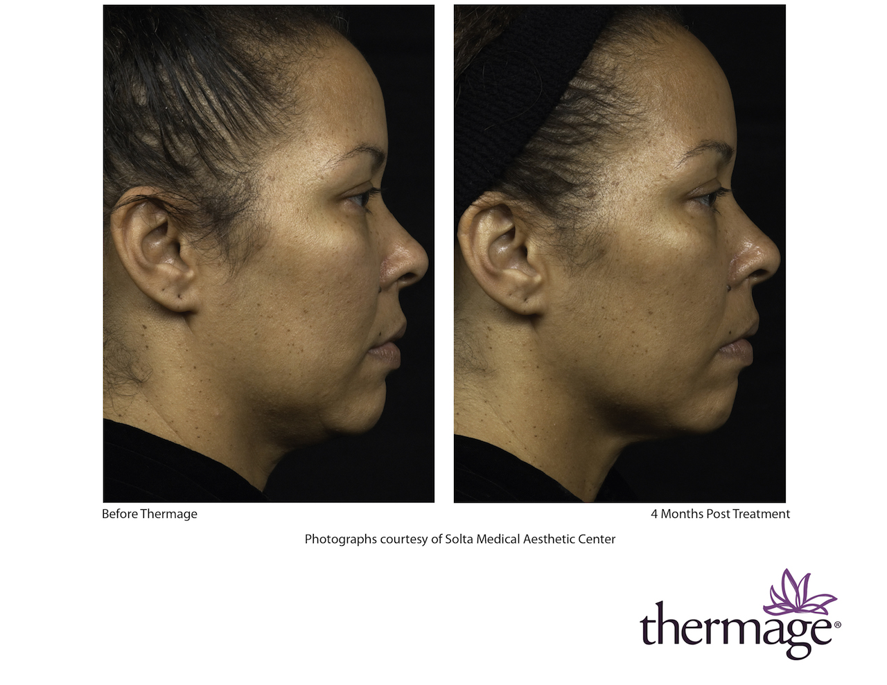 thermage treatment before and after