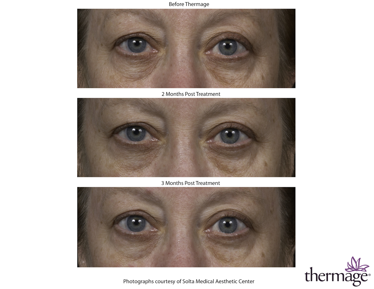 thermage treatment before and after