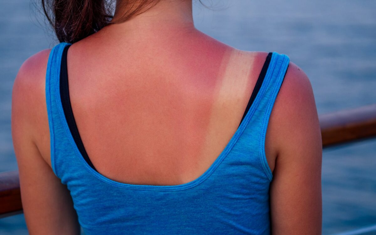 A woman with a sunburn